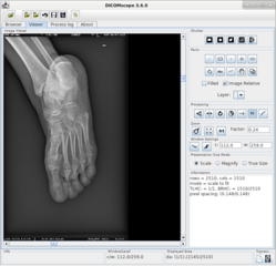 DICOMscope showing a foot radiograph