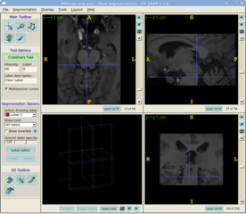semi-automatic segmentation of structures in 3D images