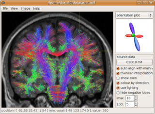 diffusion-weighted MRI white matter tractography